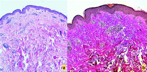 A Superficial And Deep Perivascular Lymphocytic Infiltrate With No