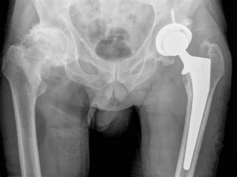 X Rays Of Dislocated Hip Replacement