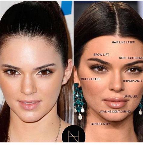 How To Become An Instagram Model Kendal Jenner Before And After Surgery Facial Fillers
