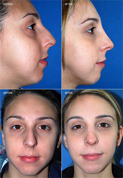 Rhinoplasty Photos Before And After Surgery Dr Douglas J Kibblewhite