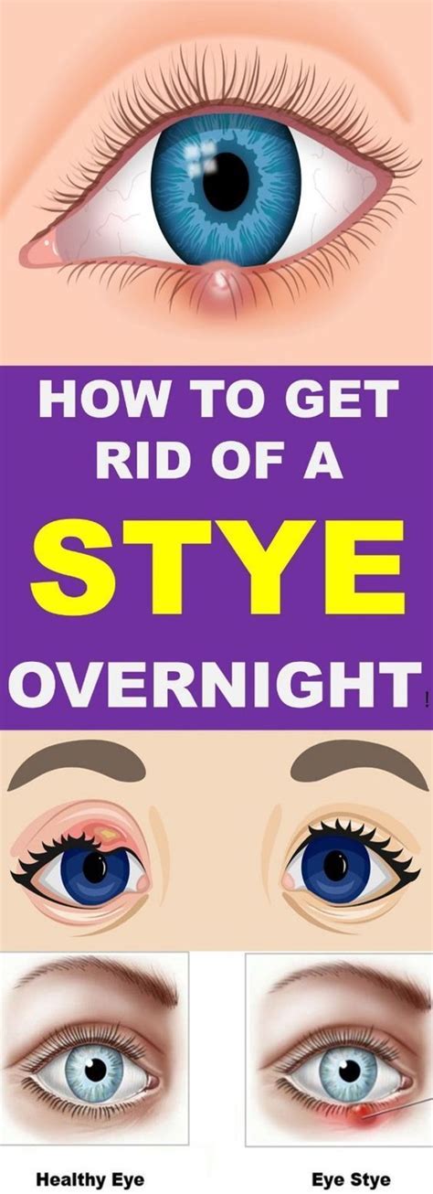 How To Get Rid Of A Stye Overnight Living Well With Oliver Stye