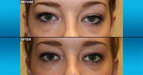 Before And After Northwest Eyelid And Orbital Specialists Ps And Neos