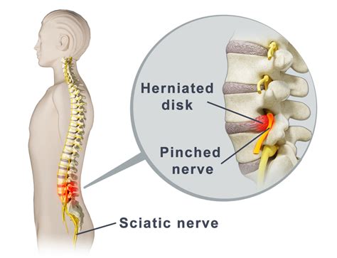 Understanding And Treating A Pinched Nerve Causes Symptoms And
