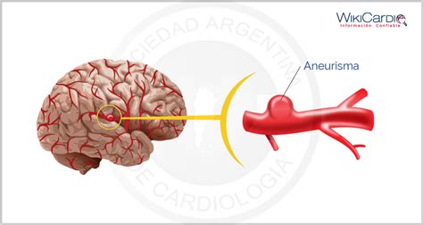 O aneurisma é uma dilatação que se forma em um vaso sanguíneo, como artérias e veias, em decorrência de uma vasodilatação anormal. O que é Aneurisma (Cerebral, Abdominal, etc), sintomas ...