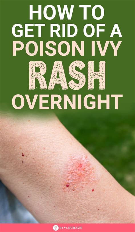 How To Get Rid Of A Poison Ivy Rash Overnight In 2021 Poison Ivy Rash
