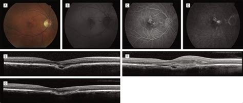 The Expanded Spectrum Of Focal Choroidal Excavation Ophthalmic