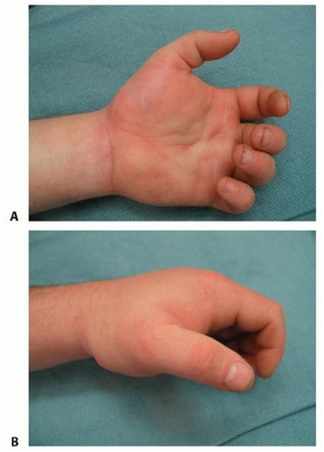 Surgical Decompression Of The Forearm Hand And Digits For Compartment
