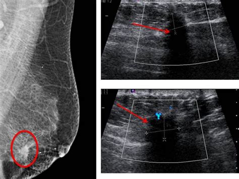 Breast Page 2 Radiology Cases