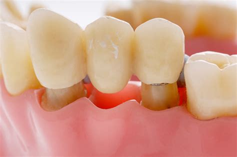 Dental Crowns And Bridges For Missing Teeth Regent