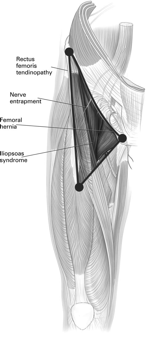 The groin muscles are a group of muscles situated high on the leg in the inner thigh. The groin triangle: a patho-anatomical approach to the ...