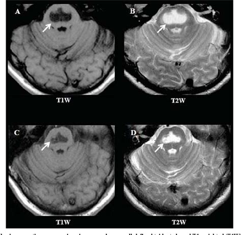 Figure From Central Pontine Myelinolysis In A Chronic Alcoholic A