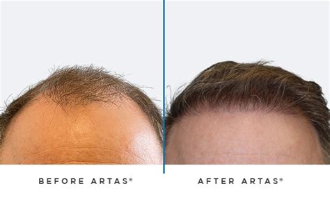 Artas Robotic Hair Transplant Austin Hair Restoration
