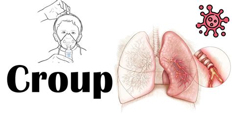 Croup Causes Pathogenesis Signs And Symptoms Diagnosis And Treatment