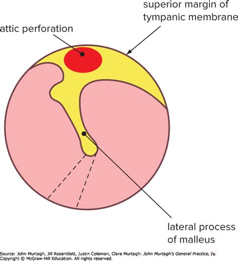 Attic Perforation Of Tympanic Membrane Image Balcony And Attic
