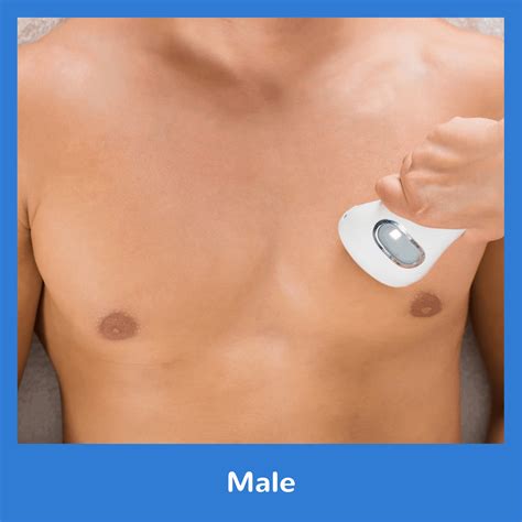male laser hair removal indy laser