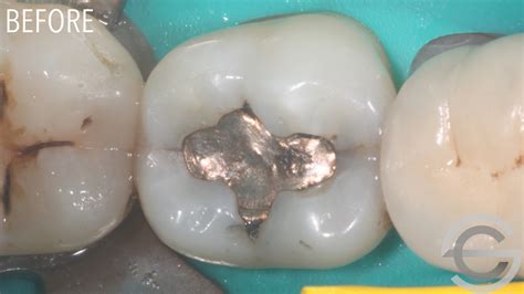 Amalgam Replacement With Cosmetic White Filling Dr Simon Chard