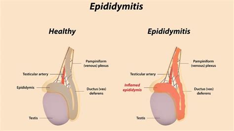 Epididymitis What Is It Symptoms Causes Diagnosis Treatment And Images
