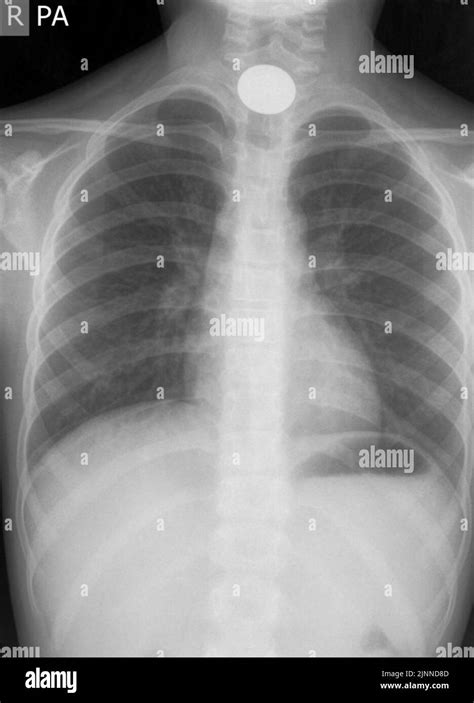 Swallowed Coin X Ray Stock Photo Alamy
