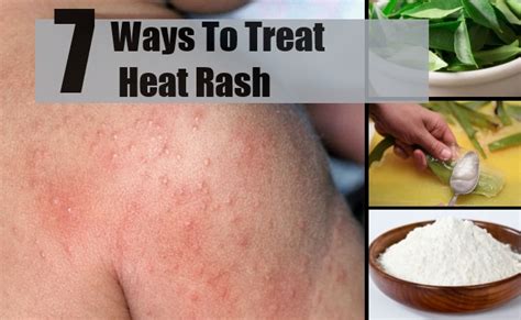 7 Ways To Treat Heat Rash Natural Treatments And Cure For Heat Rash