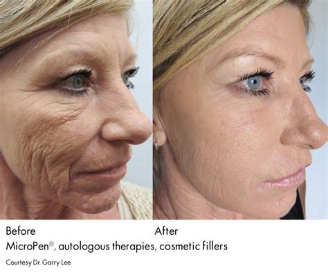 Microneedling With Prp Before And After Wrinkles Before And After
