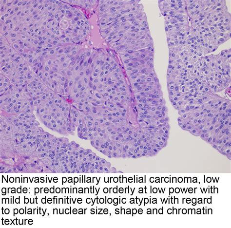 Pathology Outlines Noninvasive Papillary Urothelial Carcinoma Low Grade