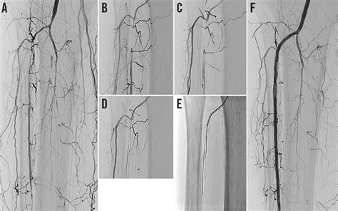Guidewires For Lower Extremity Artery Angioplasty A Review