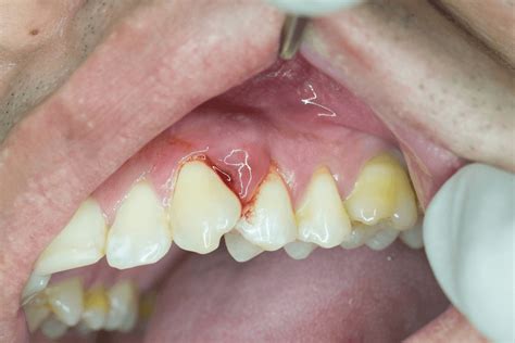 What To Do If Dental Abscess Bursts On Its Own Cards Dental