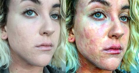 Woman With Psoriasis Shows What Its Really Like Living With The Skin Condition Huffpost Uk Life