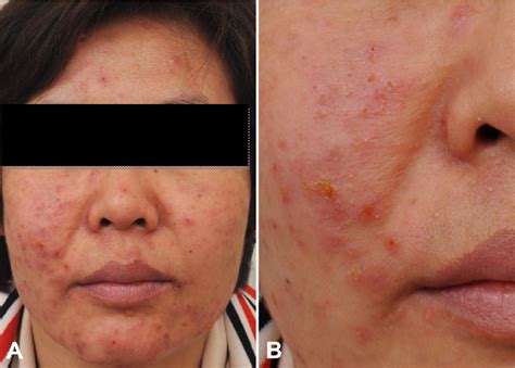 Figure 1 From Eosinophilic Pustular Folliculitis In A Patient With