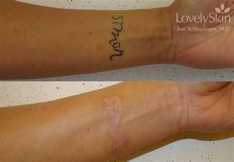 Tattoo Removal Before And After Skin Specialists Pc