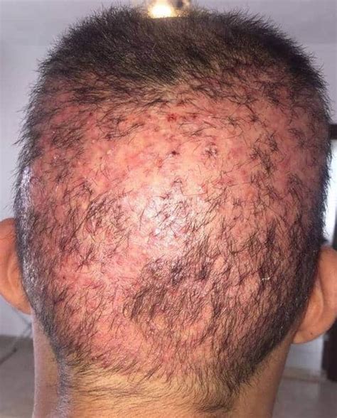 How To Fix Bad Hair Transplants Failed Hair Transplant