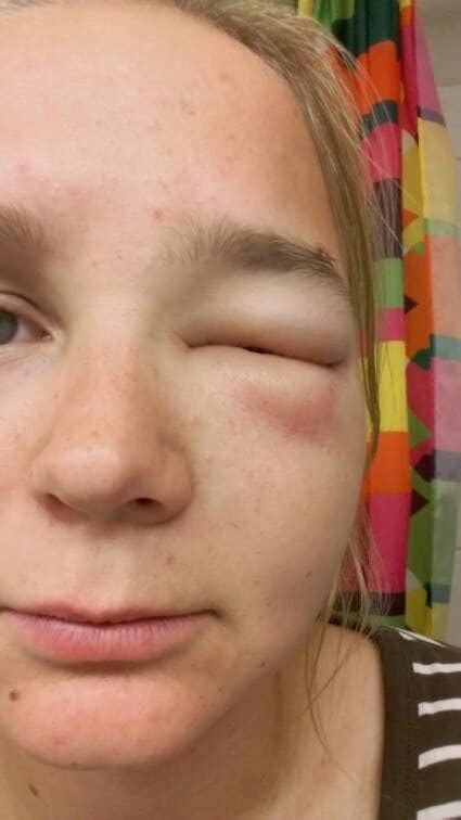 Photos Of Severe Allergic Reactions Best Allergy Sites