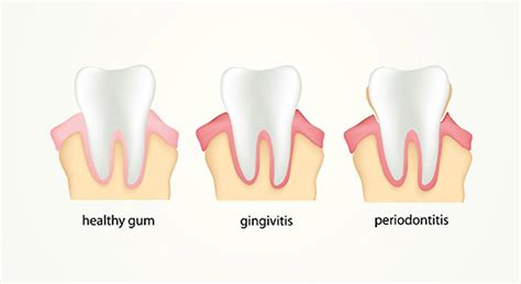 How To Tell If You Have Gum Disease 3v Dental Associates