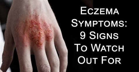 Eczema Symptoms 9 Signs To Watch Out For David Avocado Wolfe