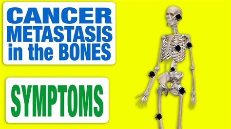 Prostate Cancer Spread To Bones Symptoms Cancerwalls