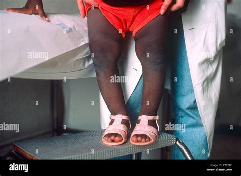 Rickets Child Hi Res Stock Photography And Images Alamy