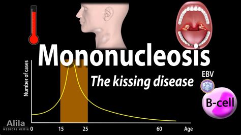 Infectious Mononucleosis Mono The Kissing Disease Animation Youtube