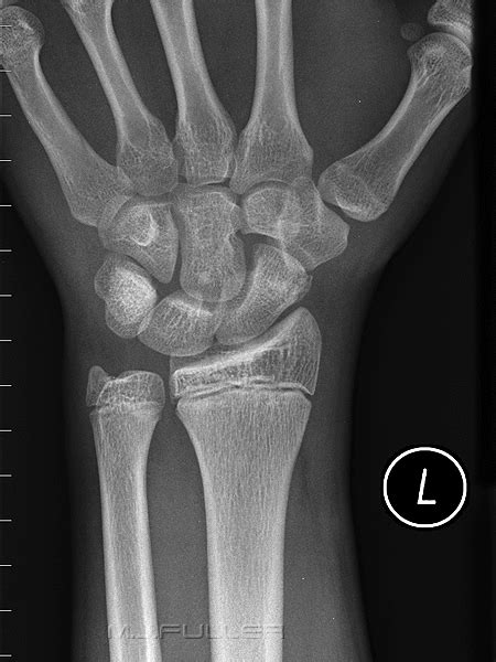 Wrist Trauma 1e Wikiradiography