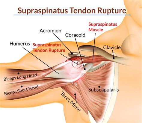 Supraspinatus Tendinitis Cause Sign Symptoms Physiotherapy Treatment