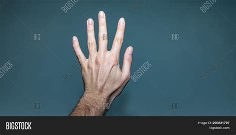 Left Hand With Broken Finger And Ganglion Cyst Image And Stock Photo