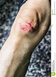 Knee after a fall stock image. Image of pain, adult, bacterium - 92592037