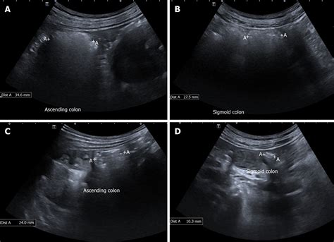 Utility Of Gastrointestinal Ultrasound In Functional Gastrointestinal