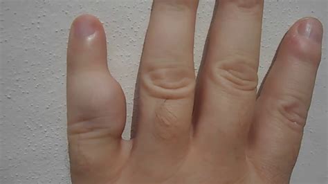 Cancer Bumps On Fingers
