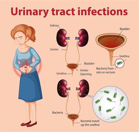 Illustration Informative Des Infections Des Voies Urinaires Vecteur Premium