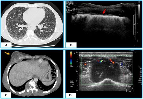 Chest Ct And Tus Appearance Of Miliary Tb A Axial Ct Scan Shows