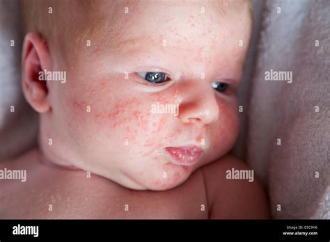 Two Week Old With Probably Neonatal Baby Acne Or Erythema Toxicum