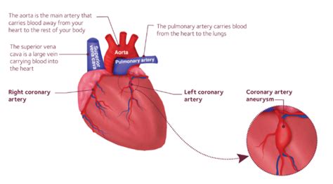 What Is A Coronary Artery Aneurysm Portrait 02 Societi