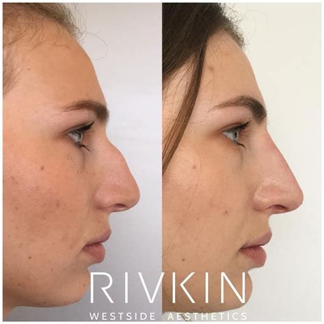 nose job before and after bump before and after