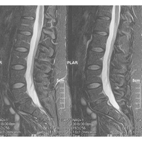 Lateral X Rays Demonstrating A L4 L5 Grade 1 Spondylolisthesis The