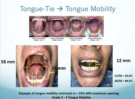 Tongue Tie And Lip Tie In Adults